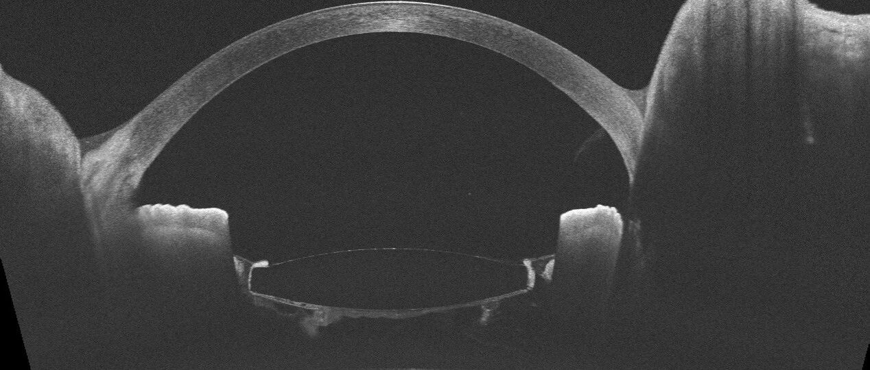 囊袋内的“秘密”——晶状体囊袋阻滞综合征（CBS）