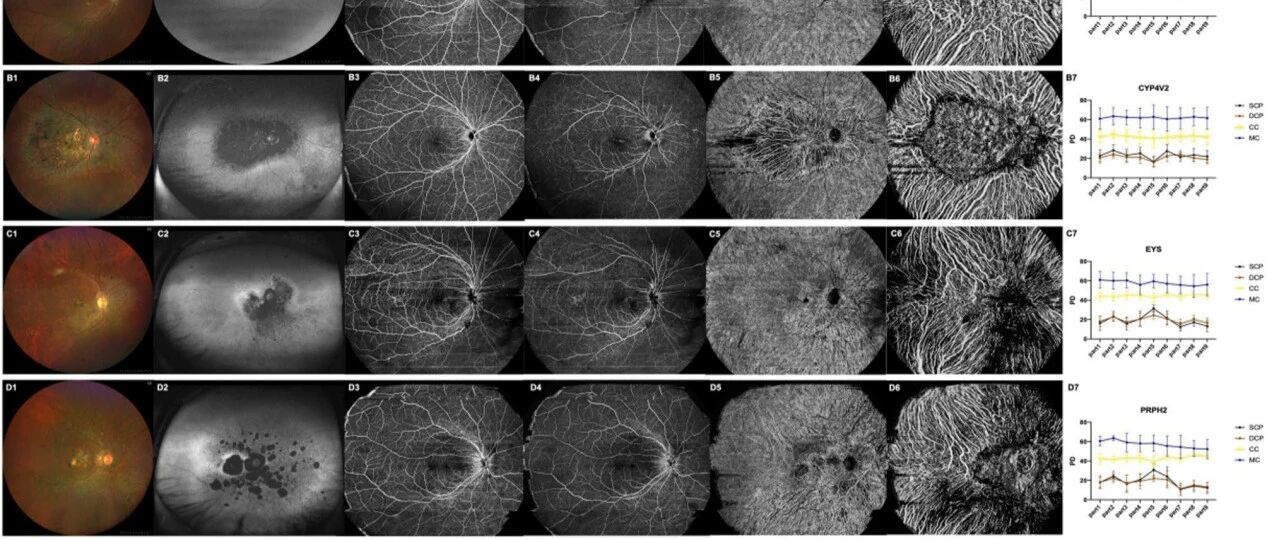 视网膜色素变性基因型特异性血流灌注特征，全域扫频OCTA新发现